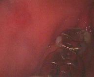 頬粘膜の咬傷